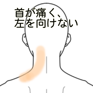 寝違えで左が向けない首の痛み 鍼灸 手技 用賀さいとう治療院 東京都世田谷区 肩背こり 突発性難聴 耳鳴りなど