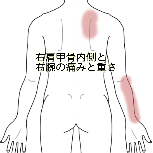 右肩甲骨内側と右腕の痛みと重さ 鍼灸 手技 用賀さいとう治療院 東京都世田谷区 肩背こり 突発性難聴 耳鳴りなど